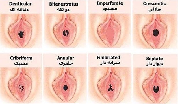 What is a Hymen-Reconstruction or Hymenorrhaphy?
